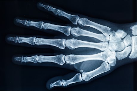 An x-ray of a human hand An x-ray of a human hand
